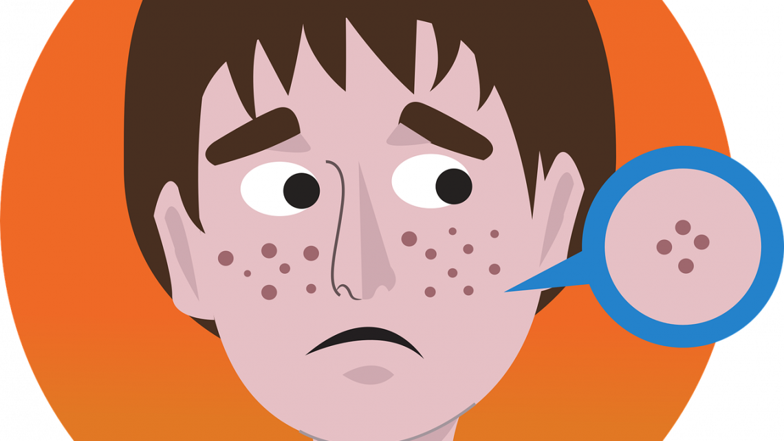 Che cos’è l’acne? In quale periodo della nostra vita fa la sua comparsa